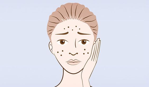 5 Acne Myths