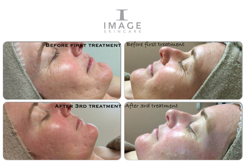 Peeling Away The Years With Glycolic