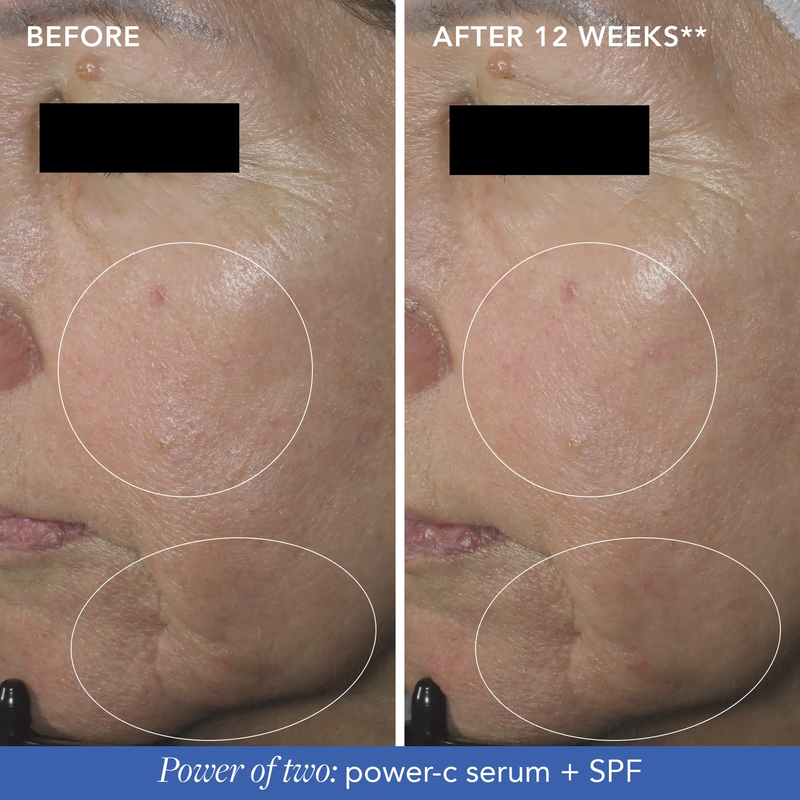 IMAGE MD® restoring power-C serum (PRESCRIPTION ONLY) - Before and After - Image Skincare Australia